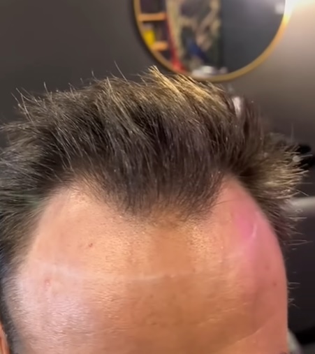 Takto vypadají kouty u mužů